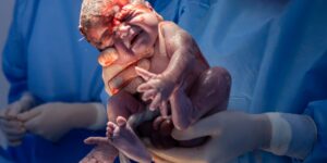 What Is a Delayed Caesarean Section